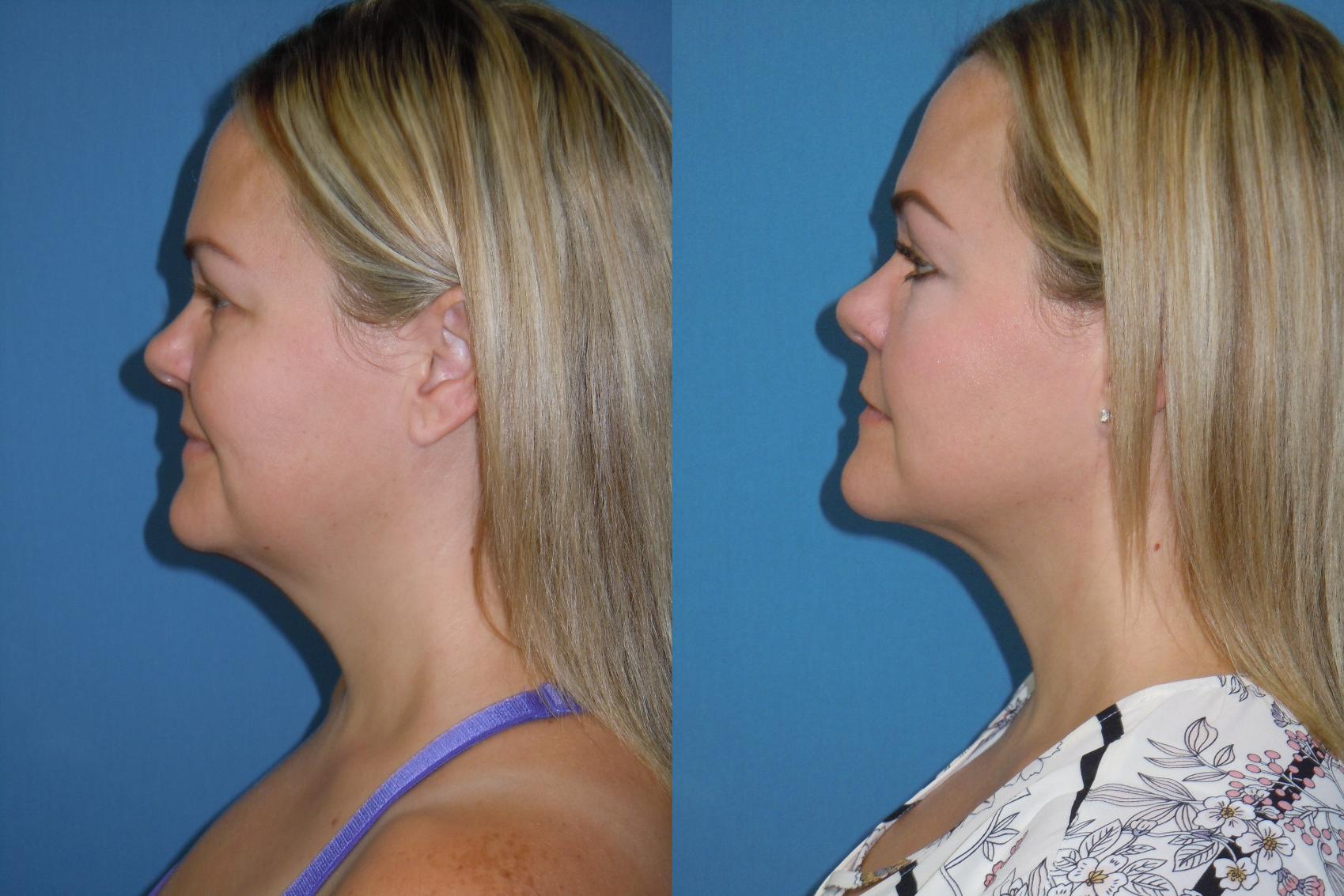 Before & After Liposuction - Neck / Precision TX Face & Neck Case 150 View #1 View in Coeur d'Alene, ID