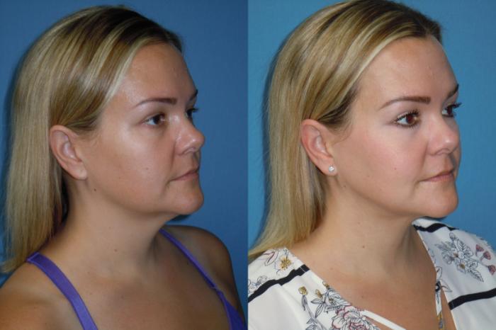 Before & After Liposuction - Neck / Precision TX Face & Neck Case 150 View #2 View in Coeur d'Alene, ID