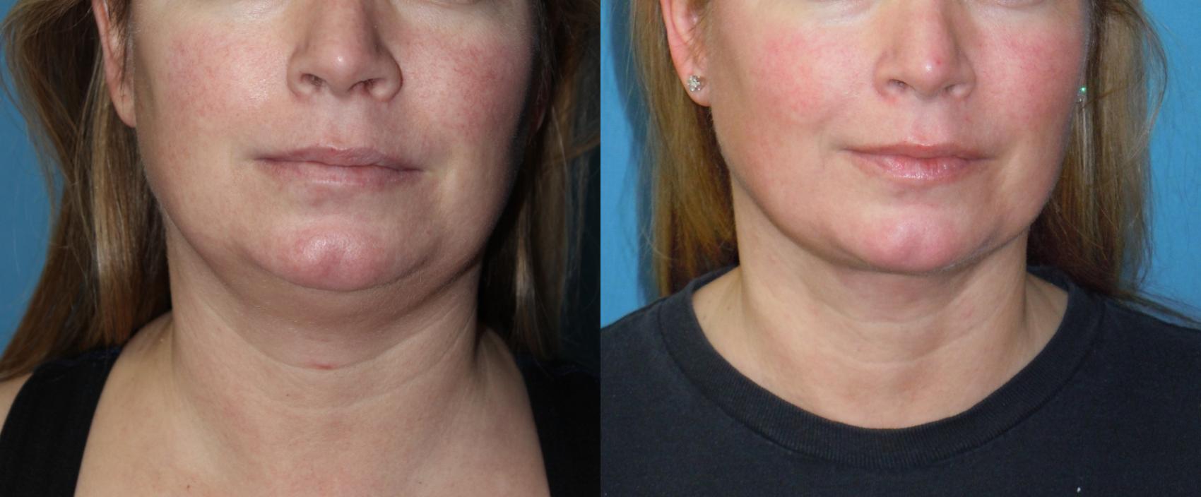 Before & After Liposuction - Neck / Precision TX Face & Neck Case 151 View #1 View in Coeur d'Alene, ID