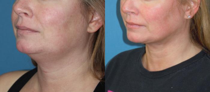Before & After Liposuction - Neck / Precision TX Face & Neck Case 151 View #2 View in Coeur d'Alene, ID
