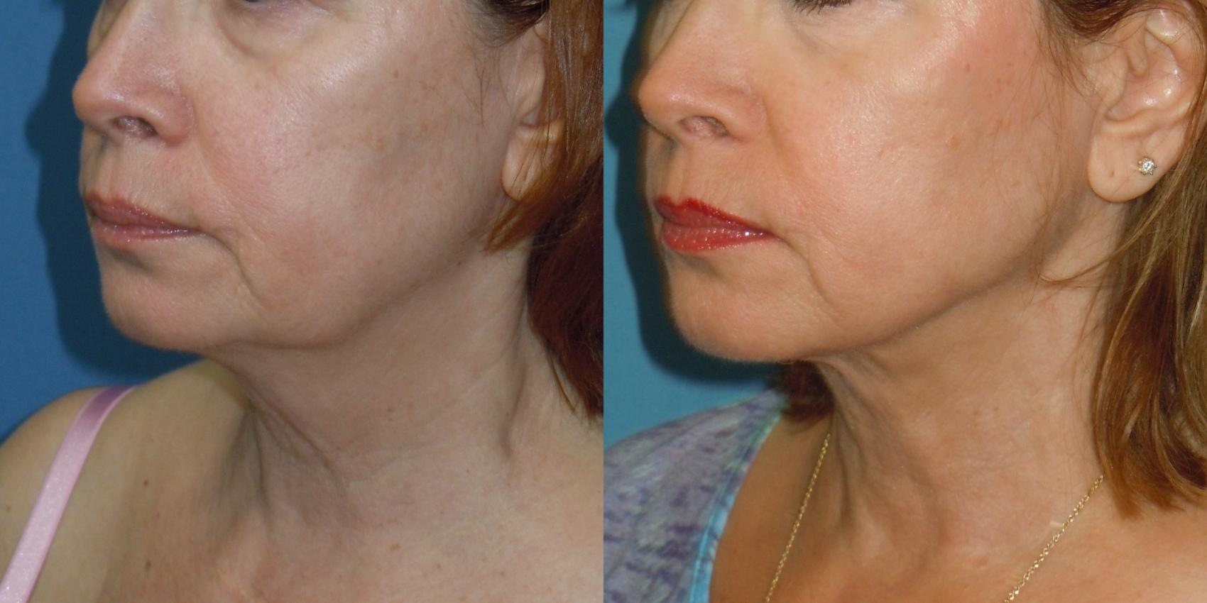 Before & After Liposuction - Neck / Precision TX Face & Neck Case 161 View #1 View in Coeur d'Alene, ID