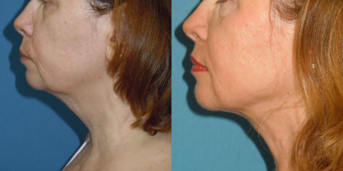 Before & After Liposuction - Neck / Precision TX Face & Neck Case 161 View #2 View in Coeur d'Alene, ID