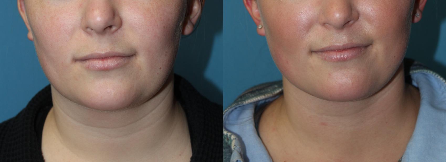 Before & After Liposuction - Neck / Precision TX Face & Neck Case 169 Front View in Coeur d'Alene, ID