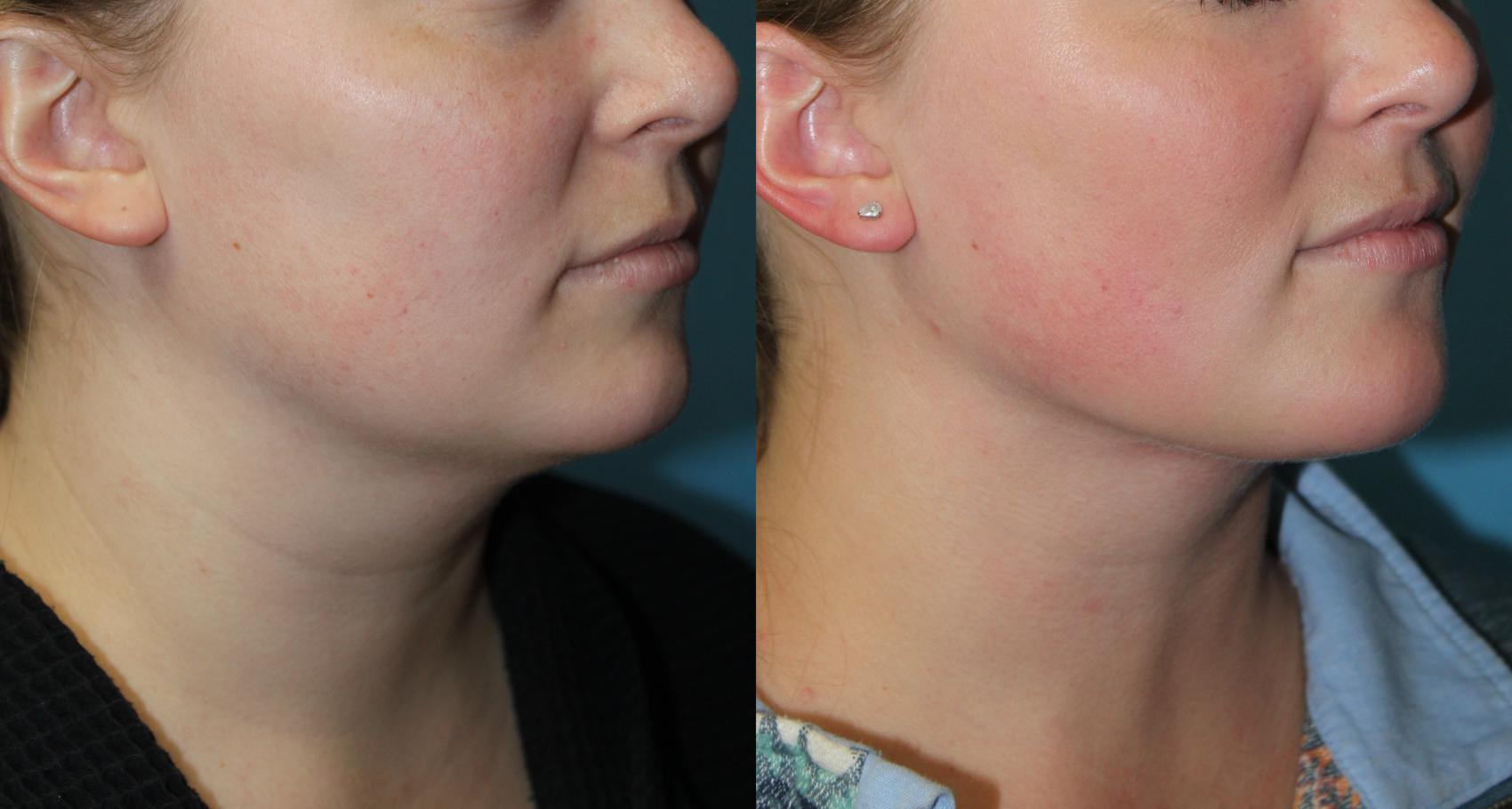 Before & After Liposuction - Neck / Precision TX Face & Neck Case 169 Right Oblique View in Coeur d'Alene, ID