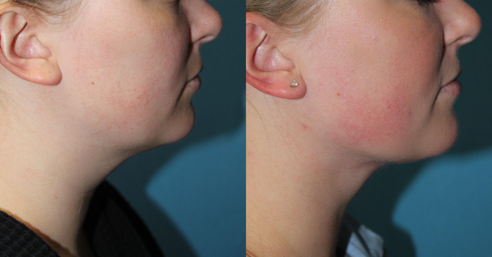 Before & After Liposuction - Neck / Precision TX Face & Neck Case 169 Right Side View in Coeur d'Alene, ID