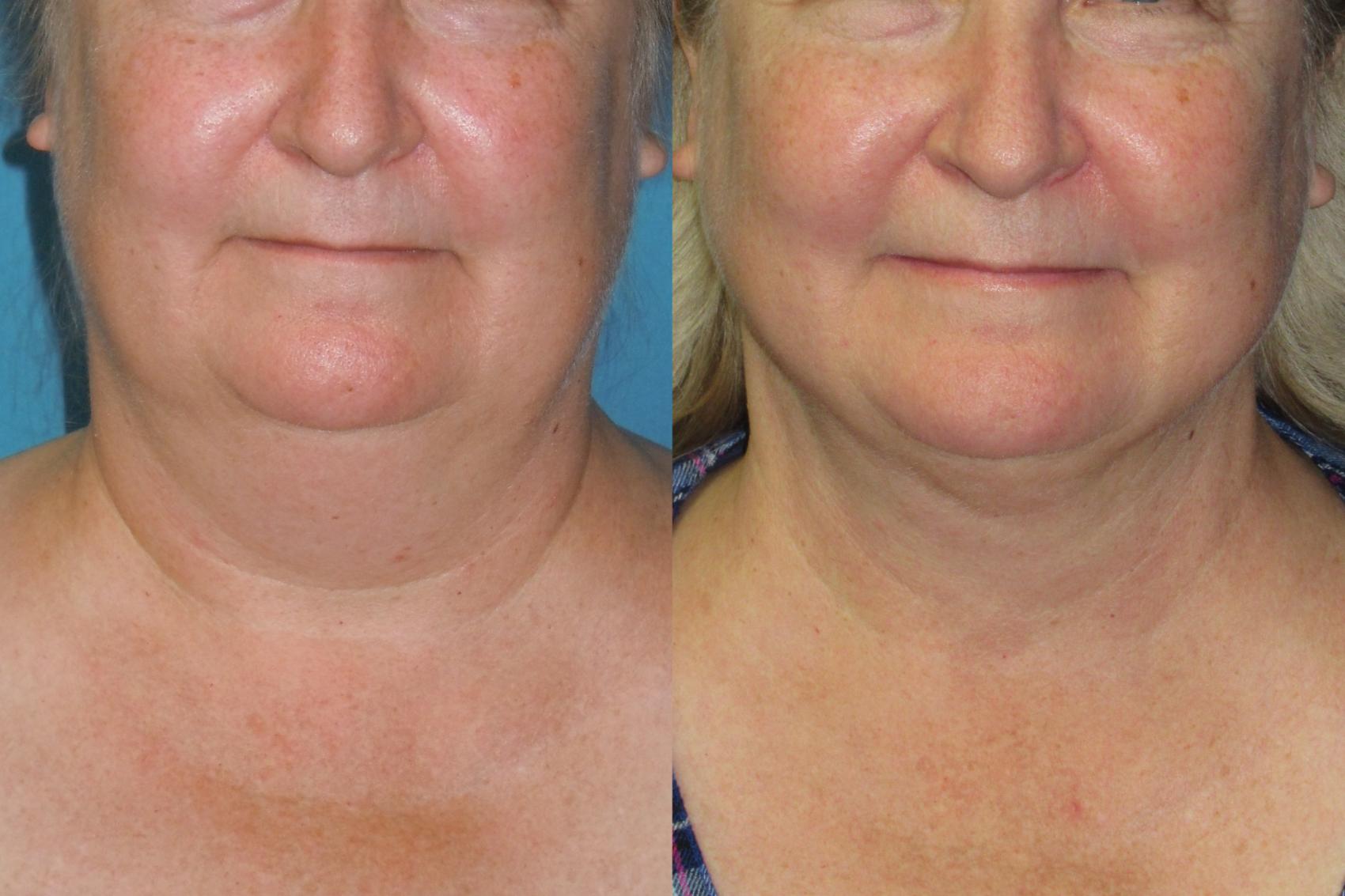 Before & After Liposuction - Neck / Precision TX Face & Neck Case 174 Front View in Coeur d'Alene, ID