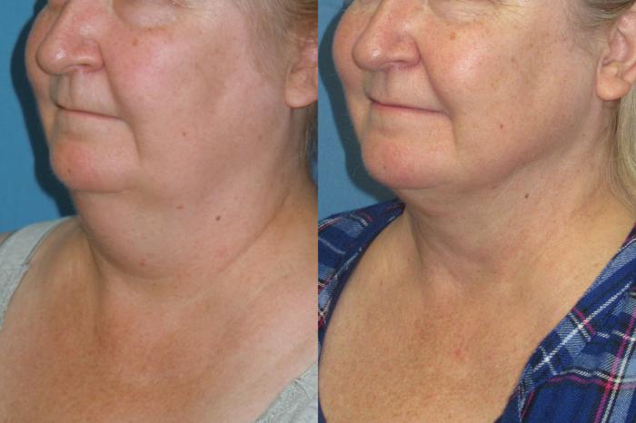 Before & After Liposuction - Neck / Precision TX Face & Neck Case 174 Left Oblique View in Coeur d'Alene, ID