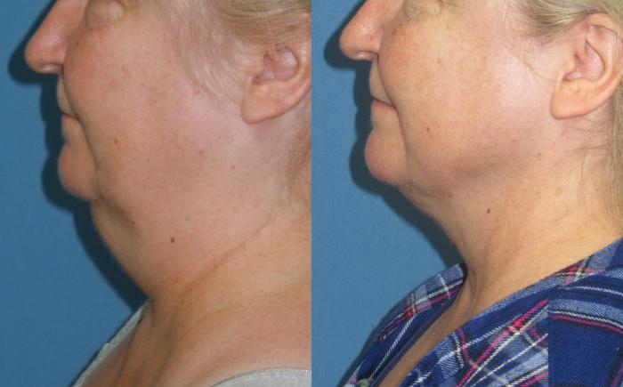 Before & After Liposuction - Neck / Precision TX Face & Neck Case 174 Left Side View in Coeur d'Alene, ID