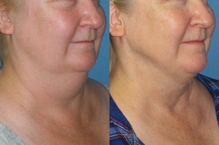 Before & After Liposuction - Neck / Precision TX Face & Neck Case 174 Right Oblique View in Coeur d'Alene, ID