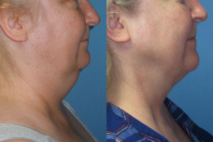 Before & After Liposuction - Neck / Precision TX Face & Neck Case 174 Right Side View in Coeur d'Alene, ID