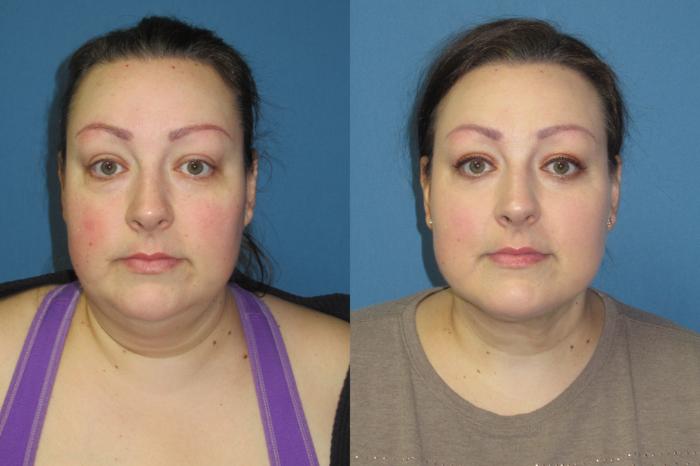 Before & After Liposuction - Neck / Precision TX Face & Neck Case 181 Front View in Coeur d'Alene, ID