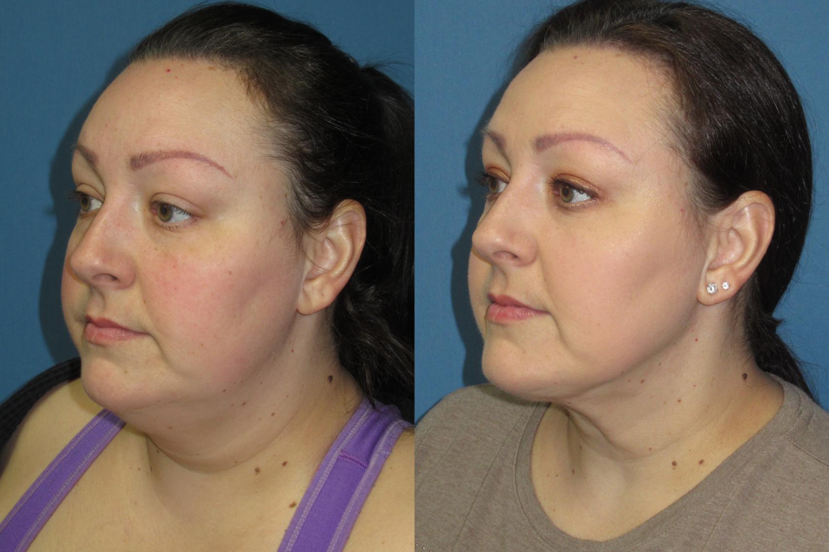 Before & After Liposuction - Neck / Precision TX Face & Neck Case 181 Left Oblique View in Coeur d'Alene, ID