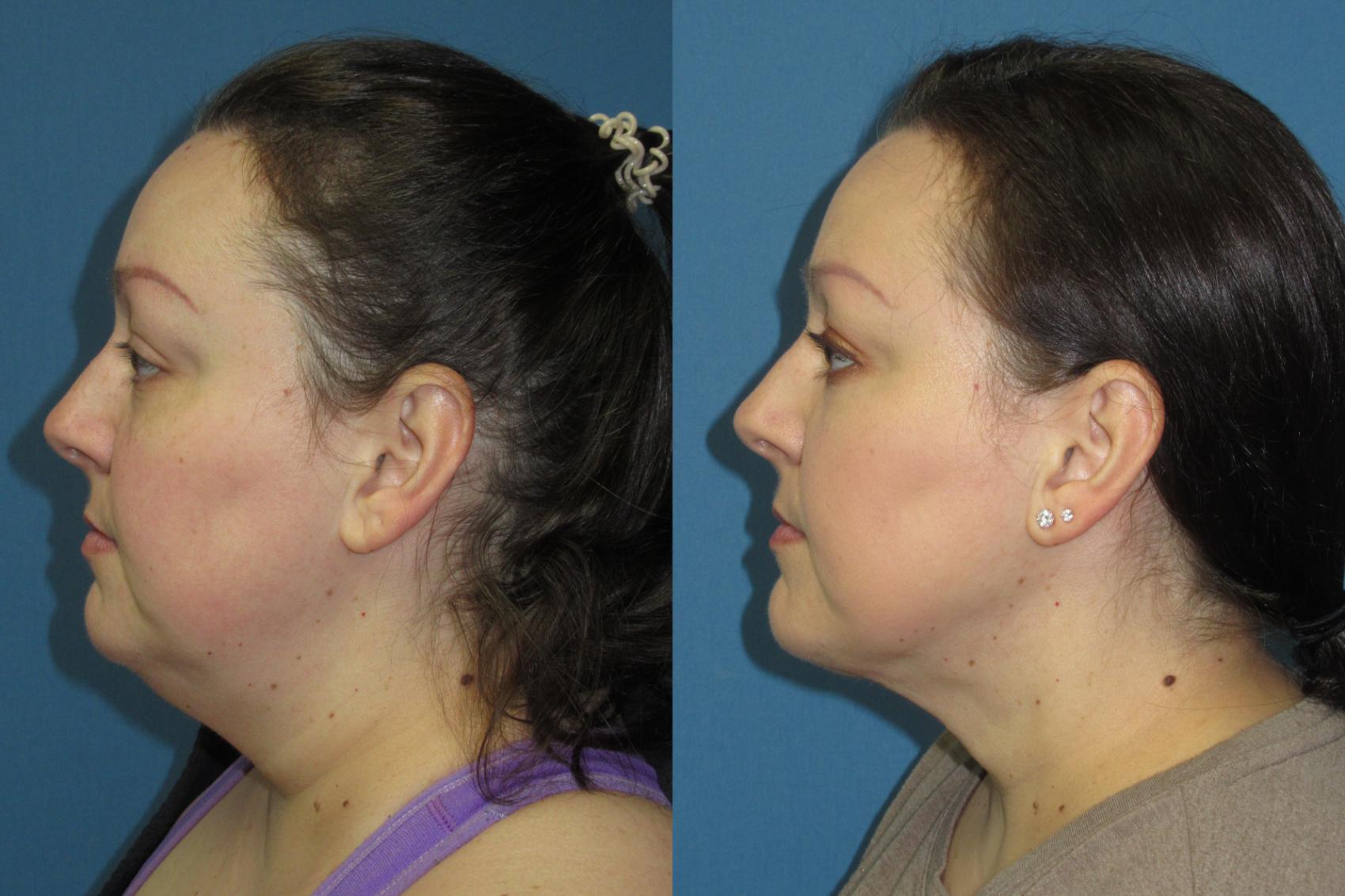 Before & After Liposuction - Neck / Precision TX Face & Neck Case 181 Left Side View in Coeur d'Alene, ID