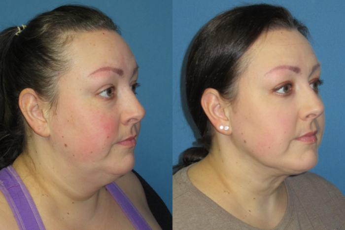 Before & After Liposuction - Neck / Precision TX Face & Neck Case 181 Right Oblique View in Coeur d'Alene, ID