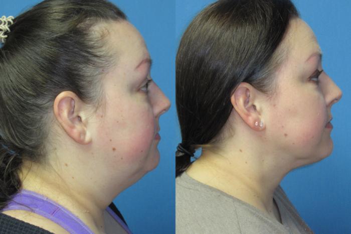 Before & After Liposuction - Neck / Precision TX Face & Neck Case 181 Right Side View in Coeur d'Alene, ID