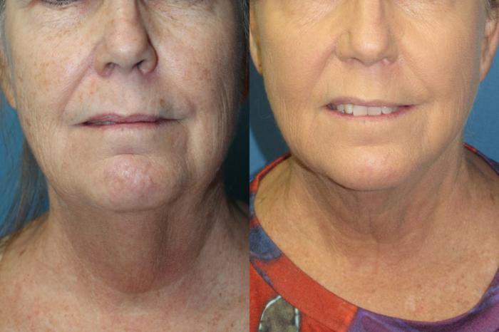 Before & After Liposuction - Neck / Precision TX Face & Neck Case 182 Front View in Coeur d'Alene, ID