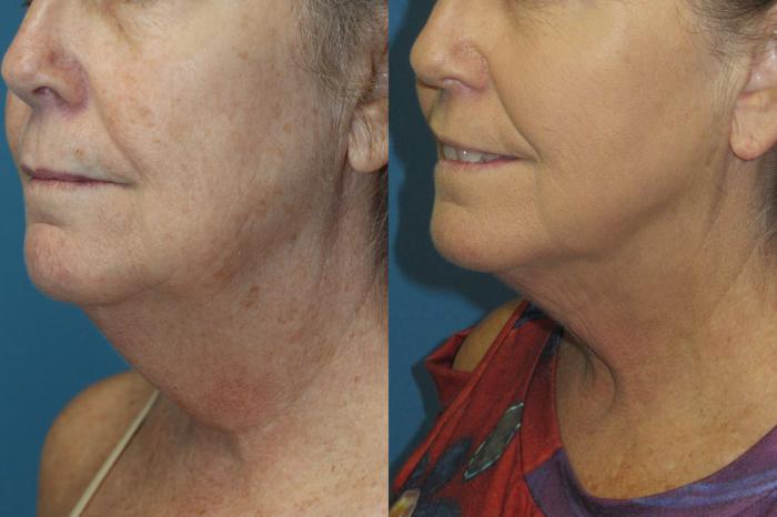 Before & After Liposuction - Neck / Precision TX Face & Neck Case 182 Left Oblique View in Coeur d'Alene, ID