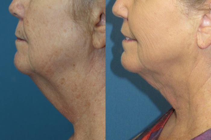 Before & After Liposuction - Neck / Precision TX Face & Neck Case 182 Left Side View in Coeur d'Alene, ID