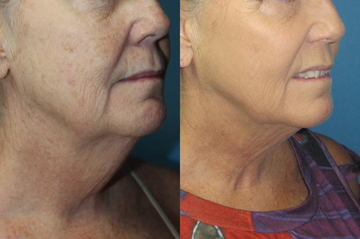 Before & After Liposuction - Neck / Precision TX Face & Neck Case 182 Right Oblique View in Coeur d'Alene, ID