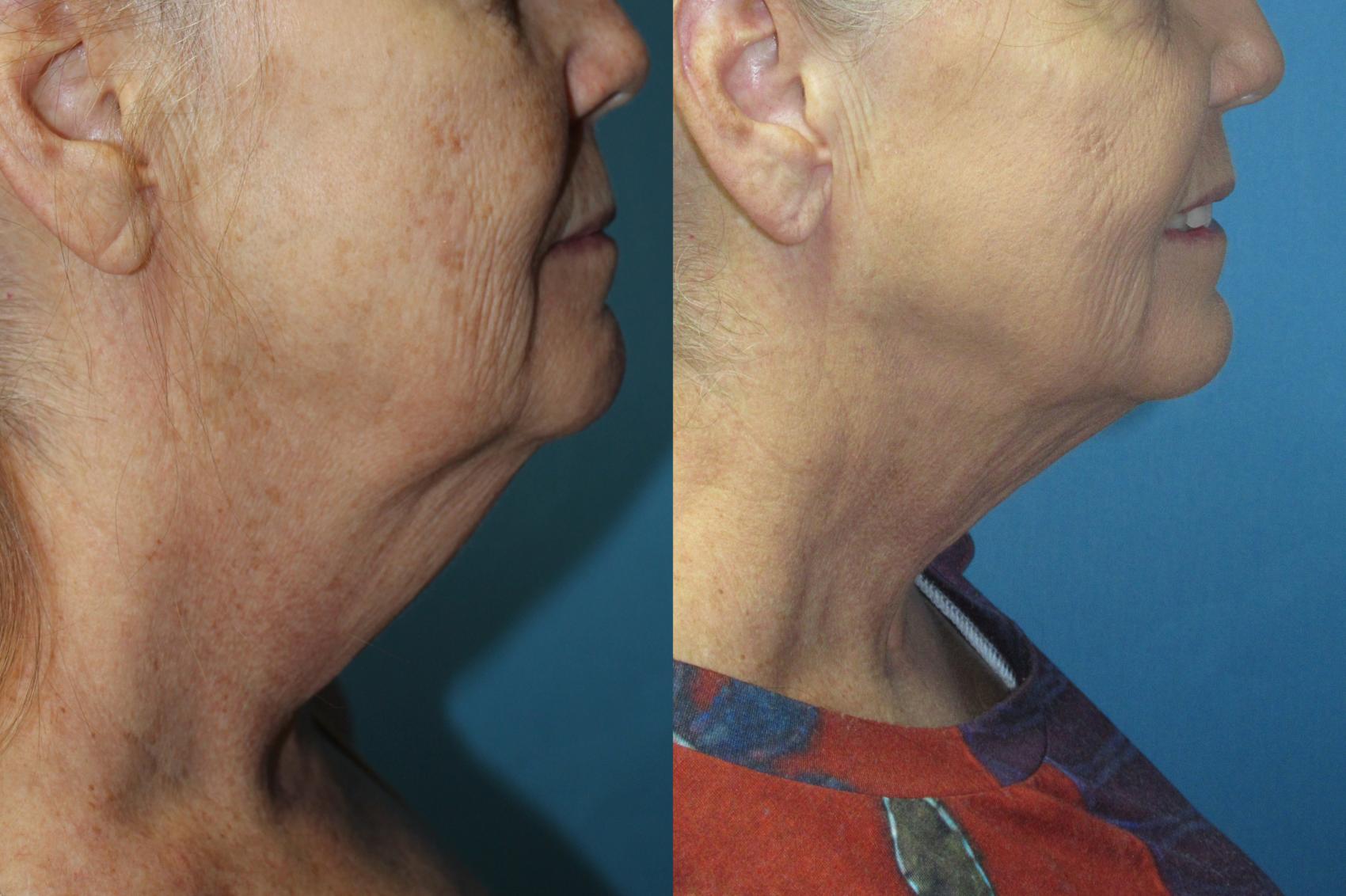 Before & After Liposuction - Neck / Precision TX Face & Neck Case 182 Right Side View in Coeur d'Alene, ID