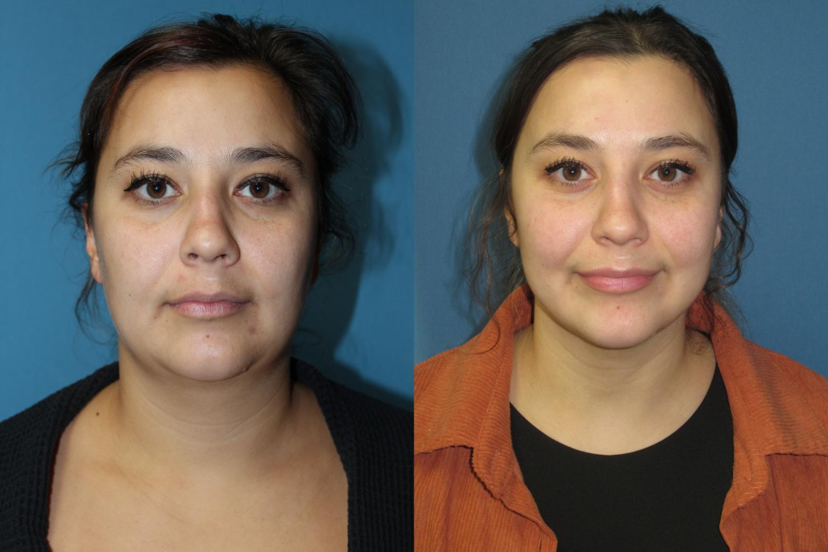Before & After Liposuction - Neck / Precision TX Face & Neck Case 185 Front View in Coeur d'Alene, ID
