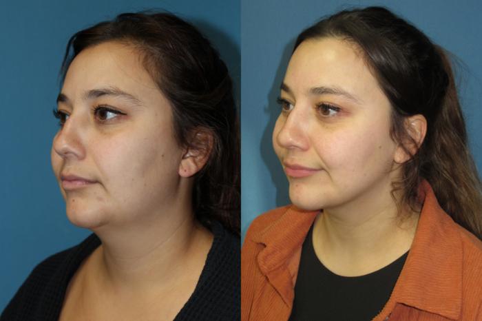 Before & After Liposuction - Neck / Precision TX Face & Neck Case 185 Left Oblique View in Coeur d'Alene, ID