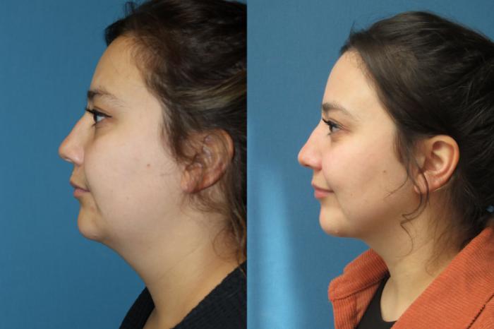Before & After Liposuction - Neck / Precision TX Face & Neck Case 185 Left Side View in Coeur d'Alene, ID