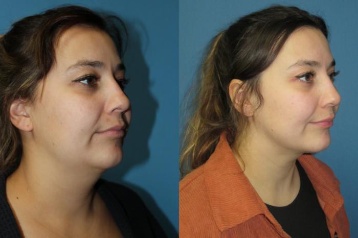 Before & After Liposuction - Neck / Precision TX Face & Neck Case 185 Right Oblique View in Coeur d'Alene, ID