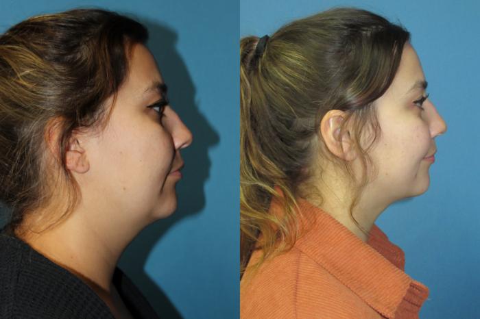 Before & After Liposuction - Neck / Precision TX Face & Neck Case 185 Right Side View in Coeur d'Alene, ID