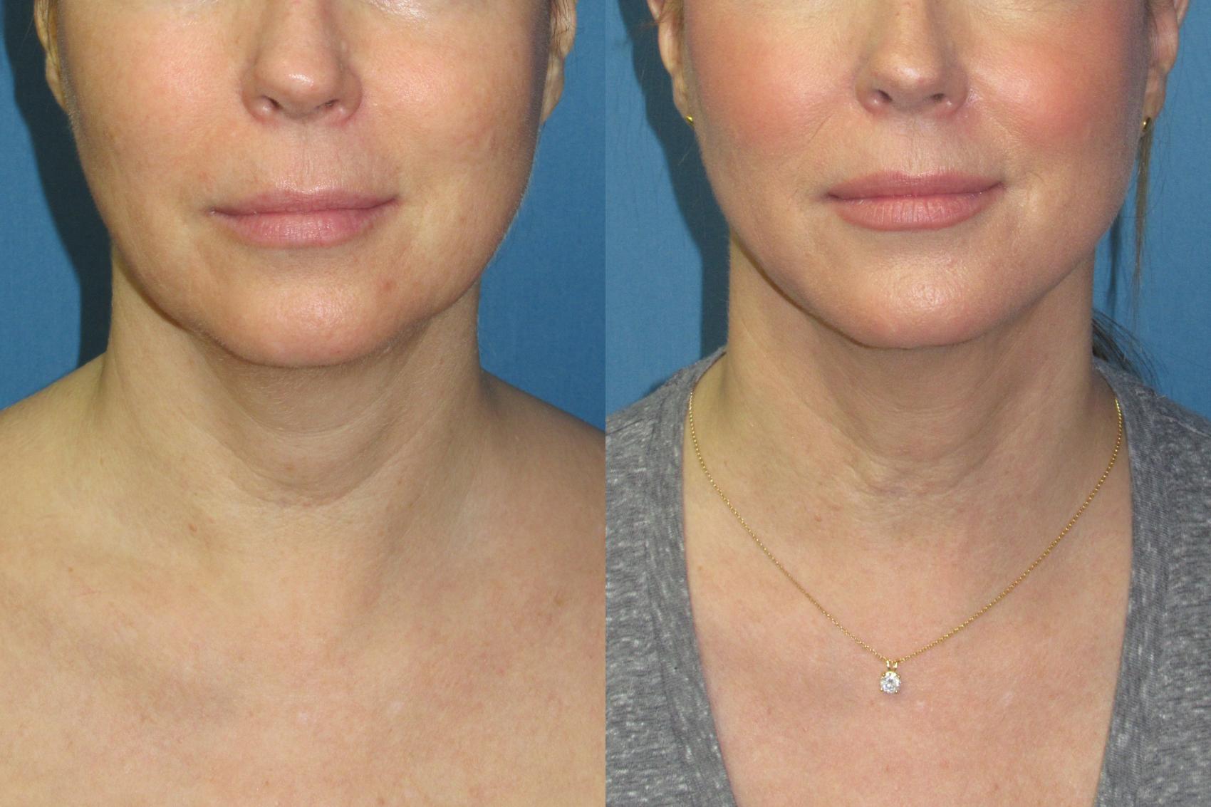 Before & After Liposuction - Neck / Precision TX Face & Neck Case 189 Front View in Coeur d'Alene, ID