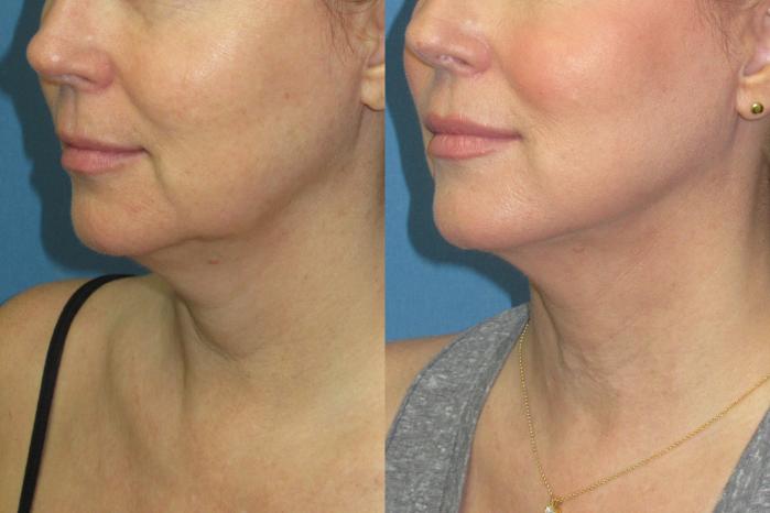 Before & After Liposuction - Neck / Precision TX Face & Neck Case 189 Left Oblique View in Coeur d'Alene, ID