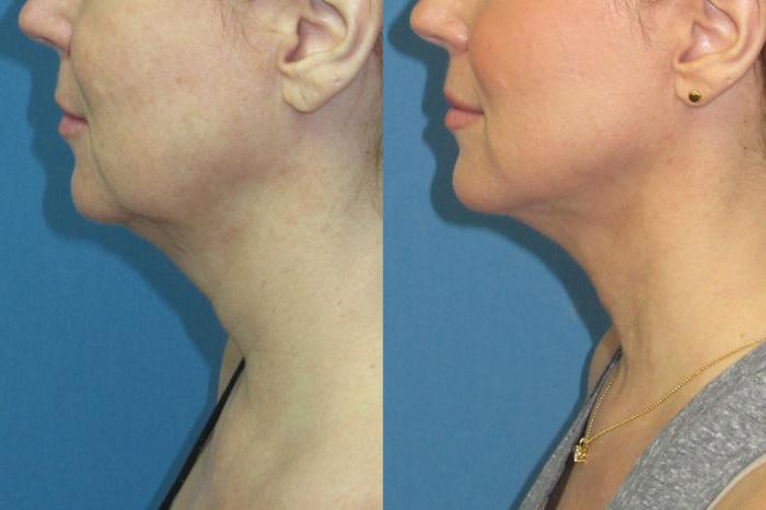Before & After Liposuction - Neck / Precision TX Face & Neck Case 189 Left side  View in Coeur d'Alene, ID