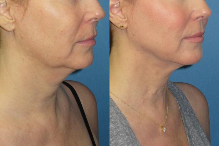 Before & After Liposuction - Neck / Precision TX Face & Neck Case 189 Right Oblique View in Coeur d'Alene, ID