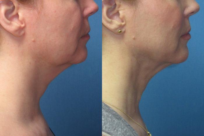 Before & After Liposuction - Neck / Precision TX Face & Neck Case 189 Right Side View in Coeur d'Alene, ID