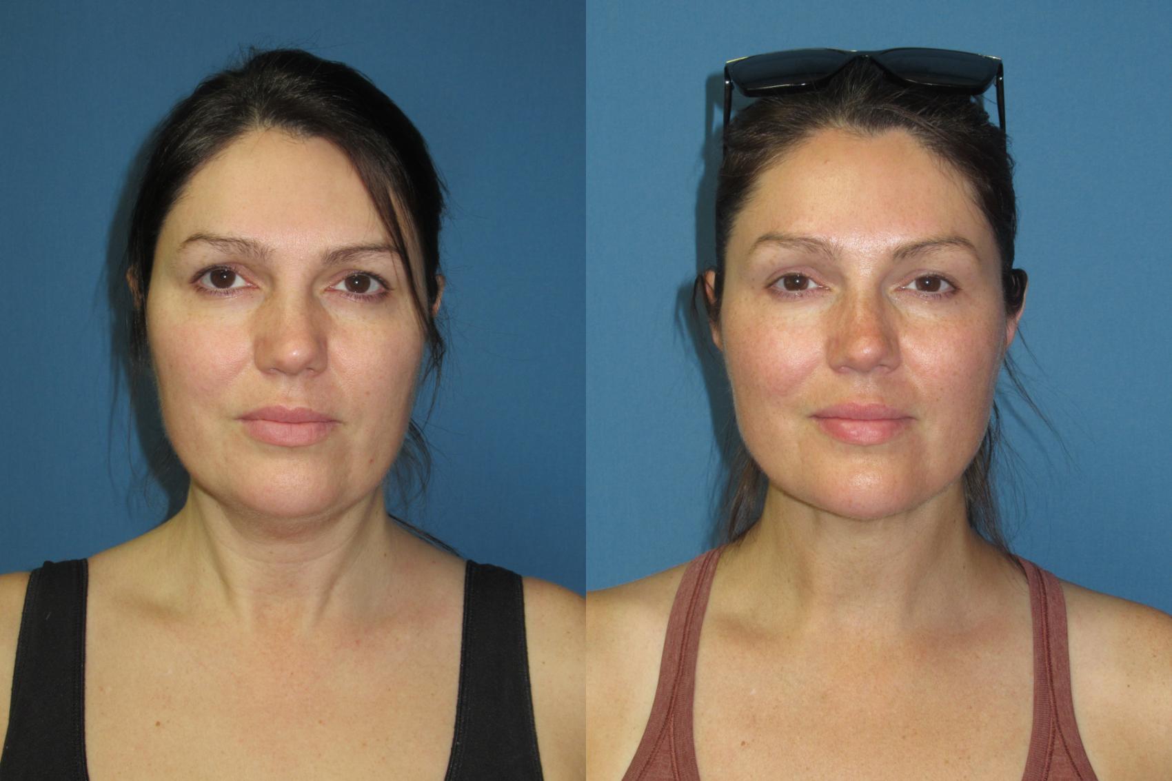 Liposuction - Neck / Precision TX Face & Neck Before & After Pictures ...