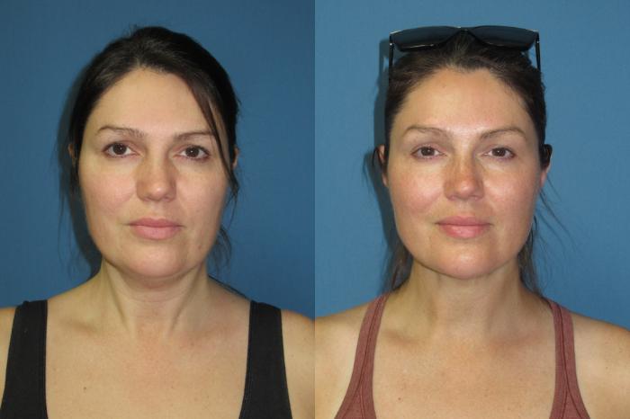 Before & After Liposuction - Neck / Precision TX Face & Neck Case 191 Front View in Coeur d'Alene, ID