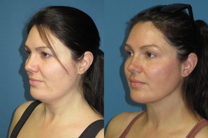 Before & After Liposuction - Neck / Precision TX Face & Neck Case 191 Left Oblique View in Coeur d'Alene, ID