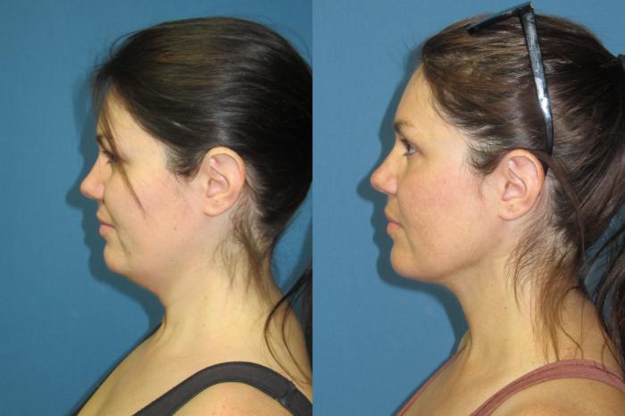 Before & After Liposuction - Neck / Precision TX Face & Neck Case 191 Left Side View in Coeur d'Alene, ID