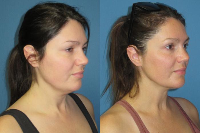 Before & After Liposuction - Neck / Precision TX Face & Neck Case 191 Right Oblique View in Coeur d'Alene, ID