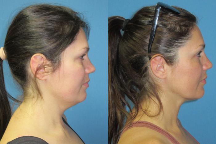 Before & After Liposuction - Neck / Precision TX Face & Neck Case 191 Right Side View in Coeur d'Alene, ID