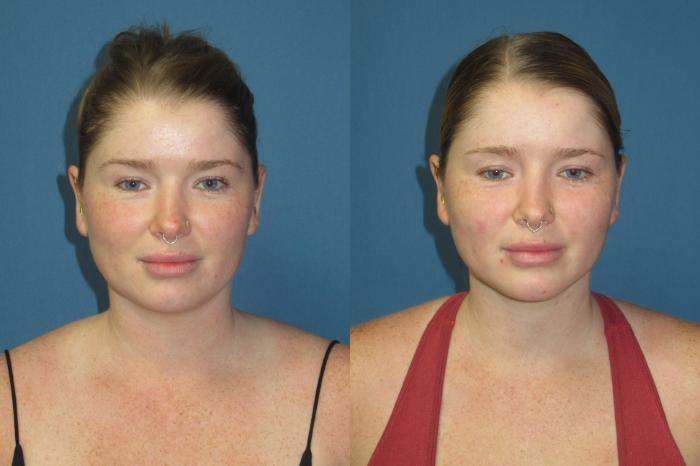 Before & After Liposuction - Neck / Precision TX Face & Neck Case 192 Front View in Coeur d'Alene, ID