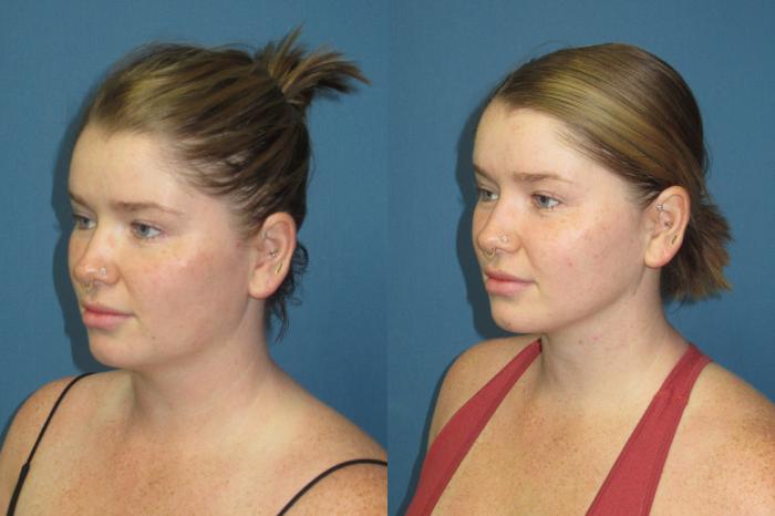 Before & After Liposuction - Neck / Precision TX Face & Neck Case 192 Left Oblique View in Coeur d'Alene, ID