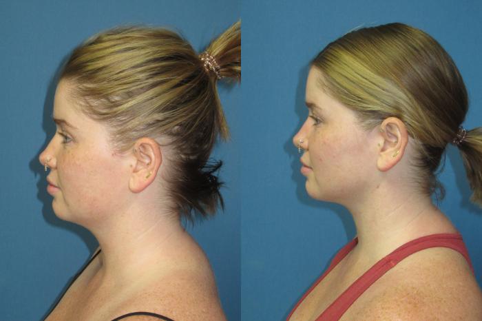 Before & After Liposuction - Neck / Precision TX Face & Neck Case 192 Left Side View in Coeur d'Alene, ID