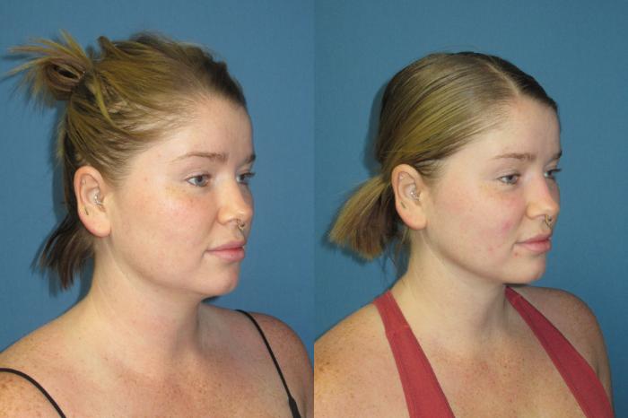 Before & After Liposuction - Neck / Precision TX Face & Neck Case 192 Right Oblique View in Coeur d'Alene, ID