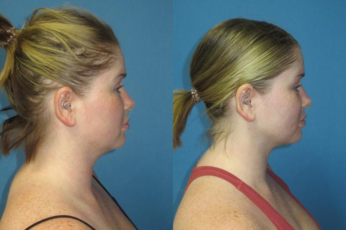 Before & After Liposuction - Neck / Precision TX Face & Neck Case 192 Right Side View in Coeur d'Alene, ID