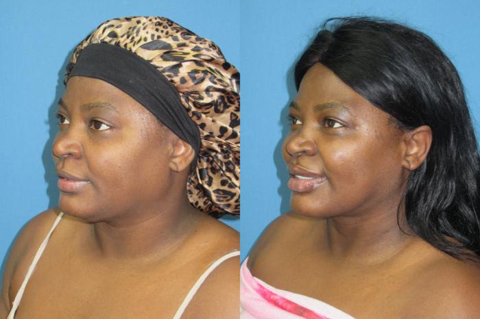 Before & After Liposuction - Neck / Precision TX Face & Neck Case 193 Left Oblique View in Coeur d'Alene, ID