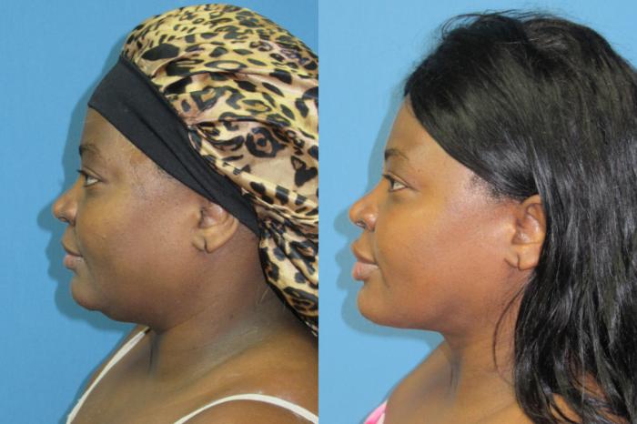 Before & After Liposuction - Neck / Precision TX Face & Neck Case 193 Left Side View in Coeur d'Alene, ID