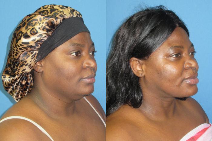 Before & After Liposuction - Neck / Precision TX Face & Neck Case 193 Right Oblique View in Coeur d'Alene, ID