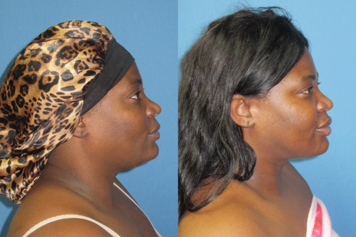 Before & After Liposuction - Neck / Precision TX Face & Neck Case 193 Right Side View in Coeur d'Alene, ID