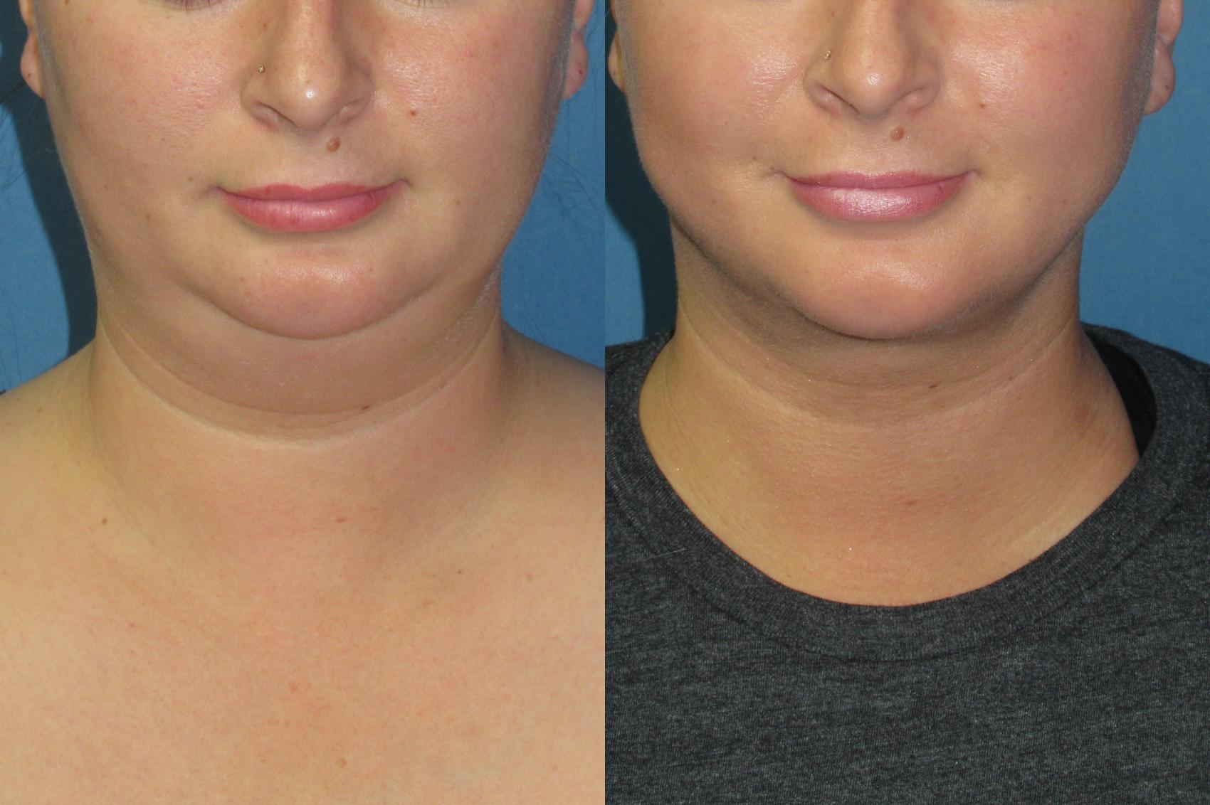 Before & After Liposuction - Neck / Precision TX Face & Neck Case 198 Front View in Coeur d'Alene, ID